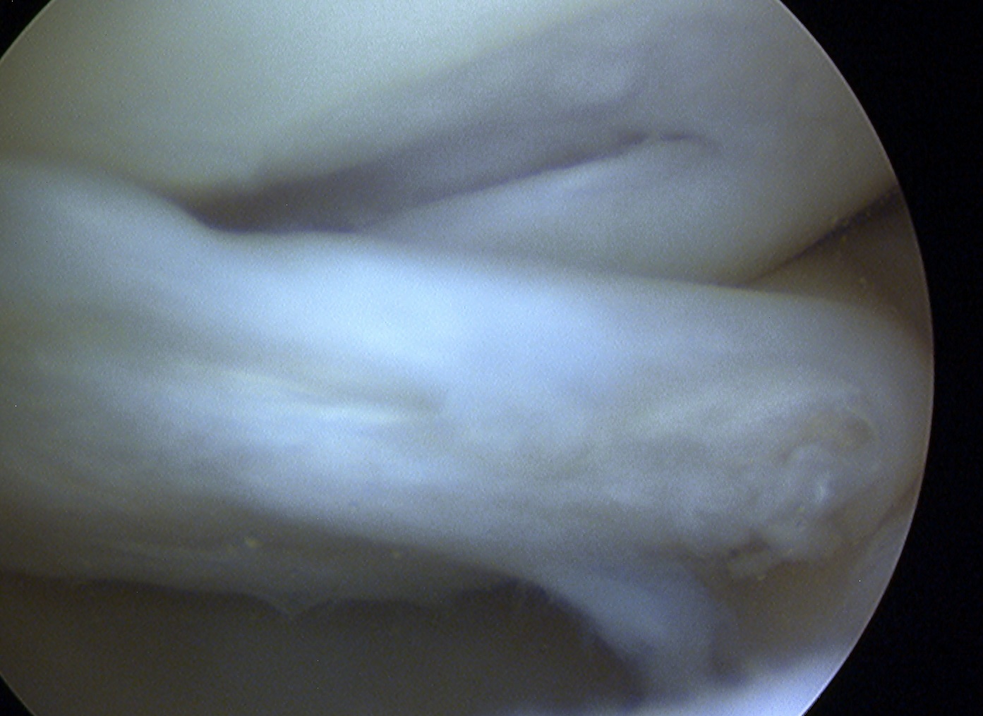 Bucket Handle Tear MM displaced anteriorly arthroscopy